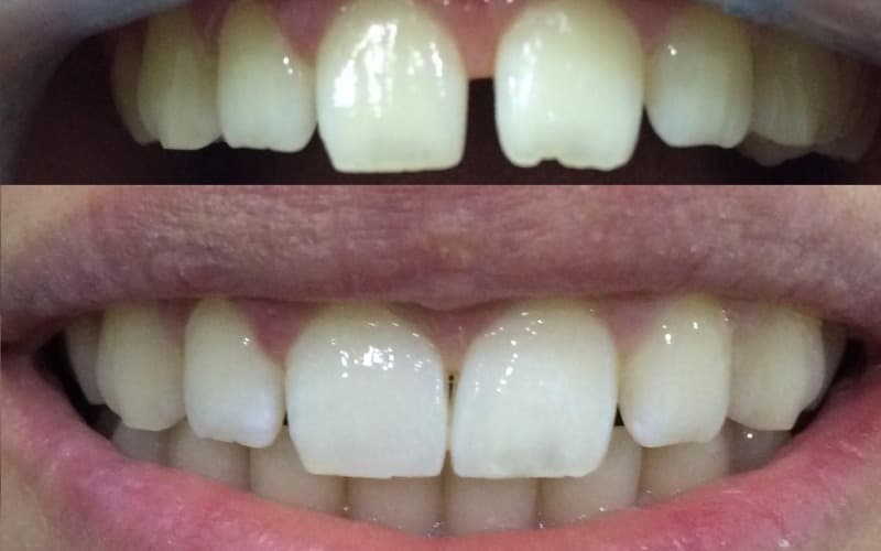 Ayrık diş tel tedavisi nedir? Nasıl yapılır? Ne kadar sürer?