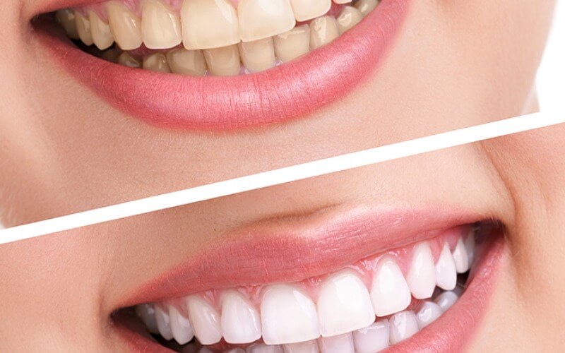 Diş beyazlatma tedavisinin detayları